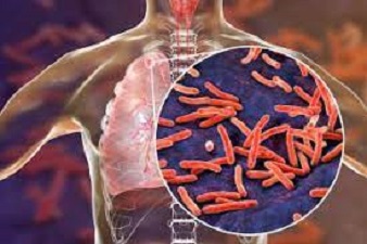 Stakeholders advocate integration of tuberculosis into health insurance