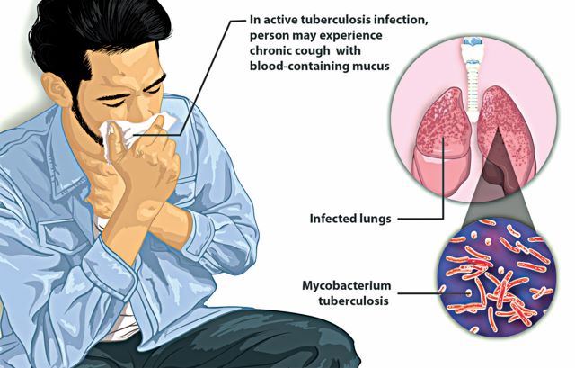 Health experts canvass increased resources to fight TB, prevent over 4,100 deaths daily