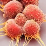 Scientists Discover Key to Stopping Aggressive Prostate Cancer Subtype