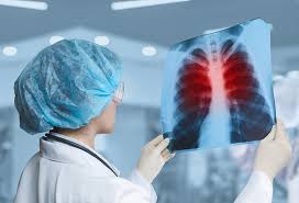 Tuberculosis resurges as top infectious disease killer