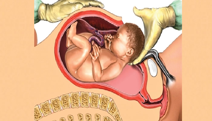 Fed Govt launches free Caesarean section for women