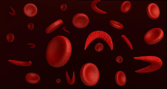 Groups partner to expand cancer, sickle cell care in Nigeria